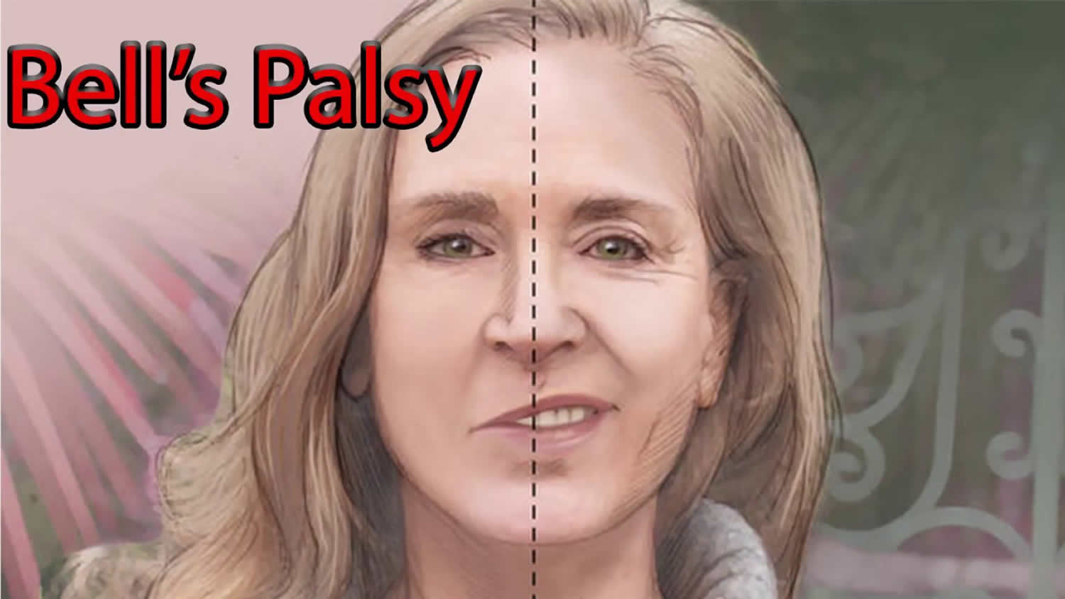 Idiopathic facial palsy