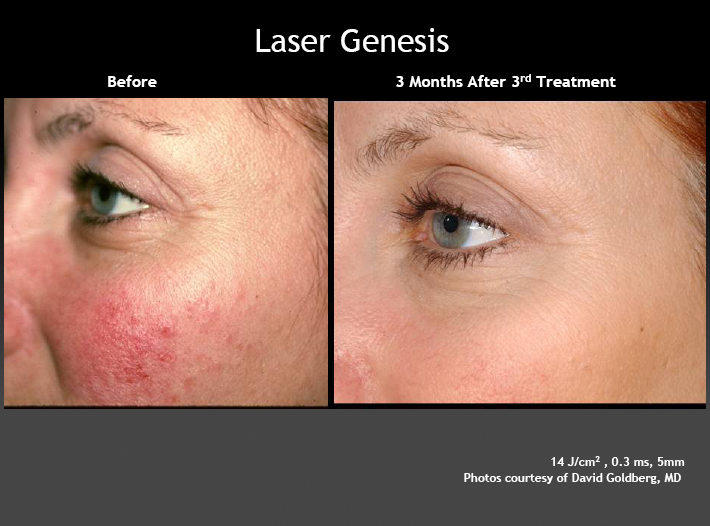 Do lasers help with facial ruddiness