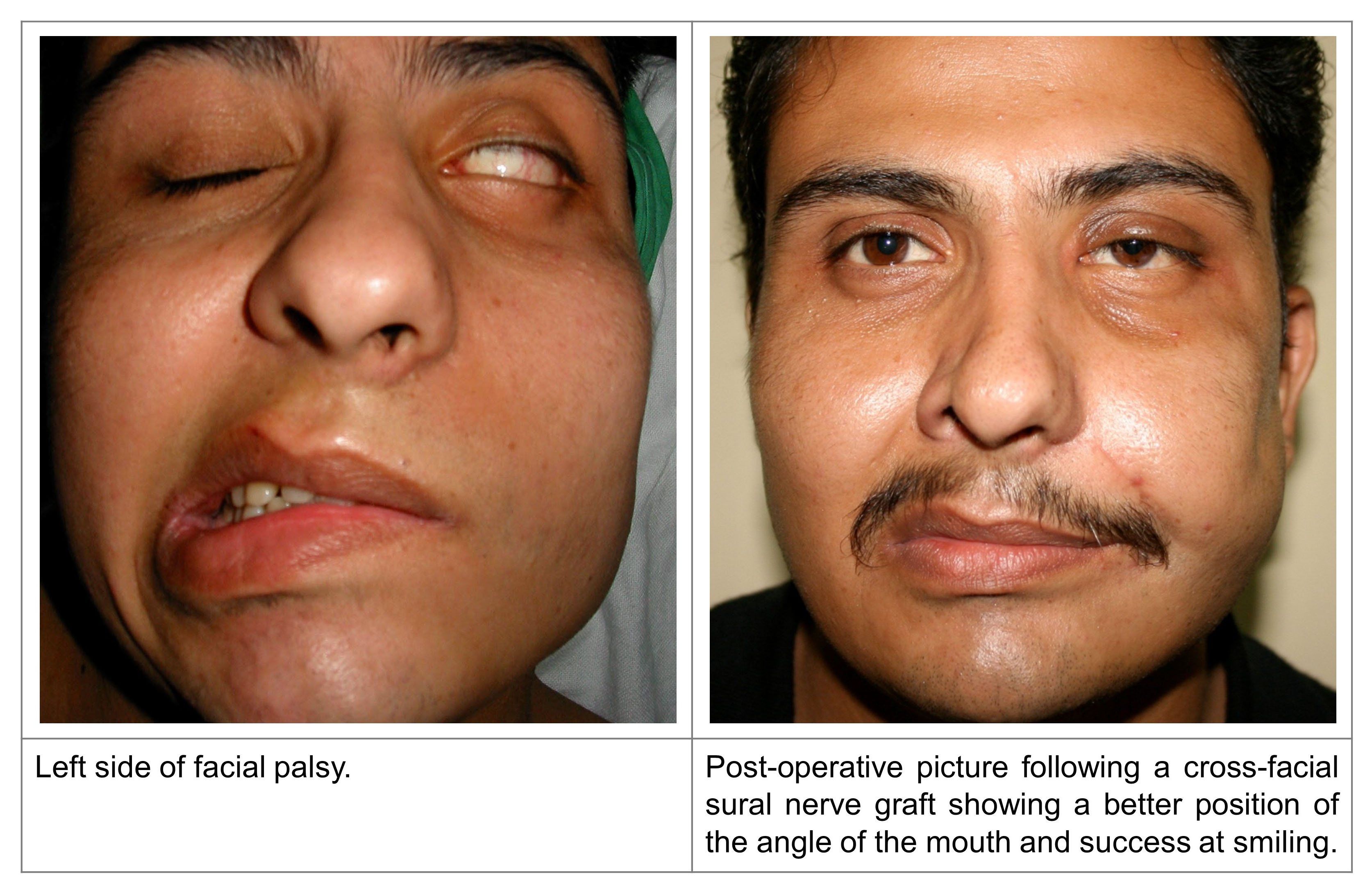best of Palsy use Facial after cocaine