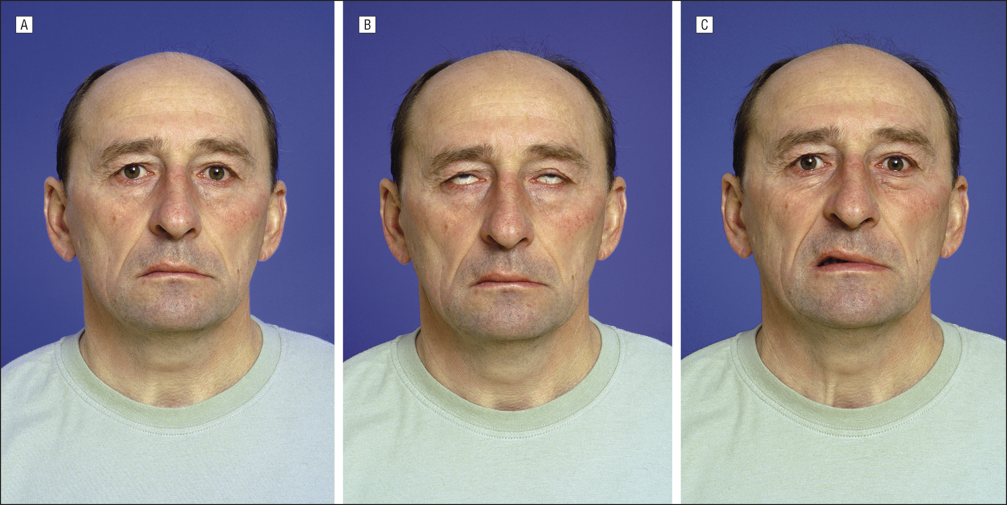 Facial palsy after cocaine use