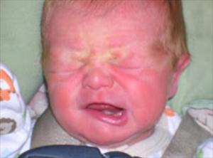 Boss reccomend Facial palsy at birth