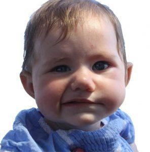 Ref reccomend Facial palsy at birth