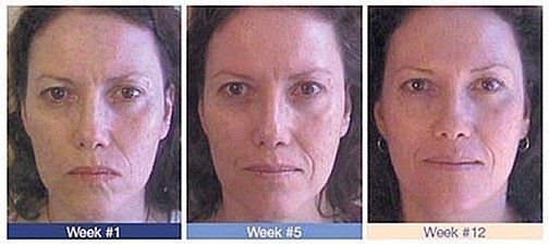 best of Acupuncture boulder rejuvenation Facial
