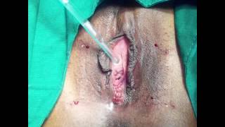 Ginger reccomend Hymenoplasty surgery virginity
