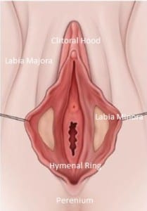 Hymenoplasty surgery virginity