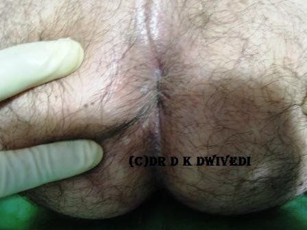 Lump adjacent to anus