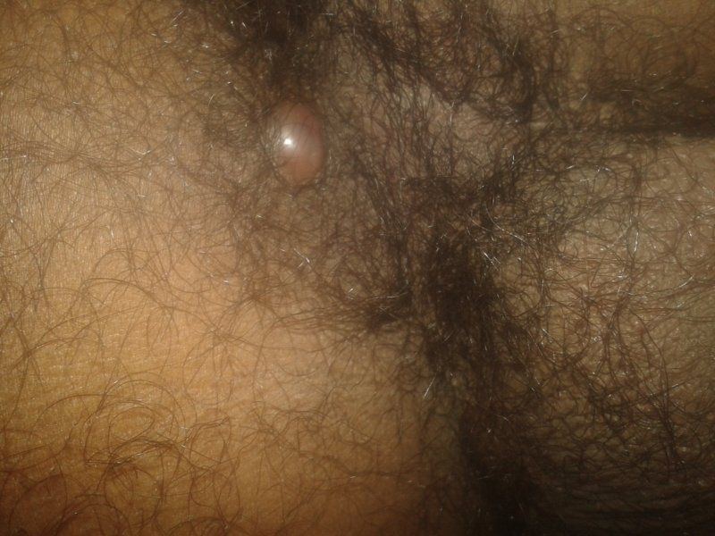 best of Under anus side skin on Lump left of