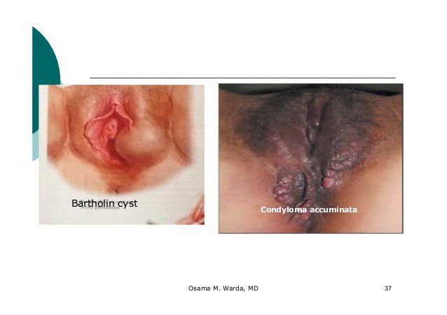 best of Cyst vagina Multiple
