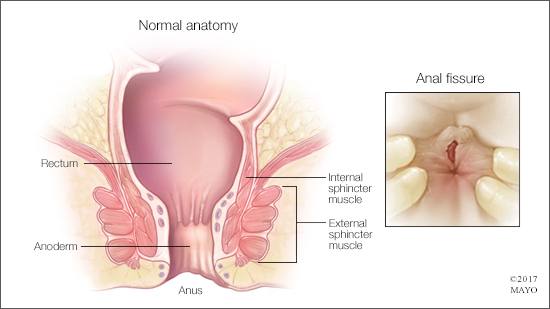 New N. reccomend Sore anus after bowel movement