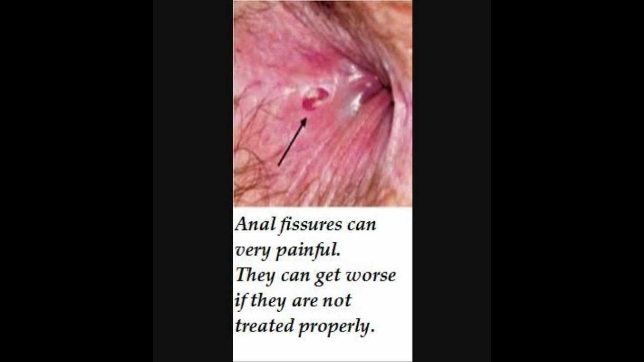 Sore skin around anus