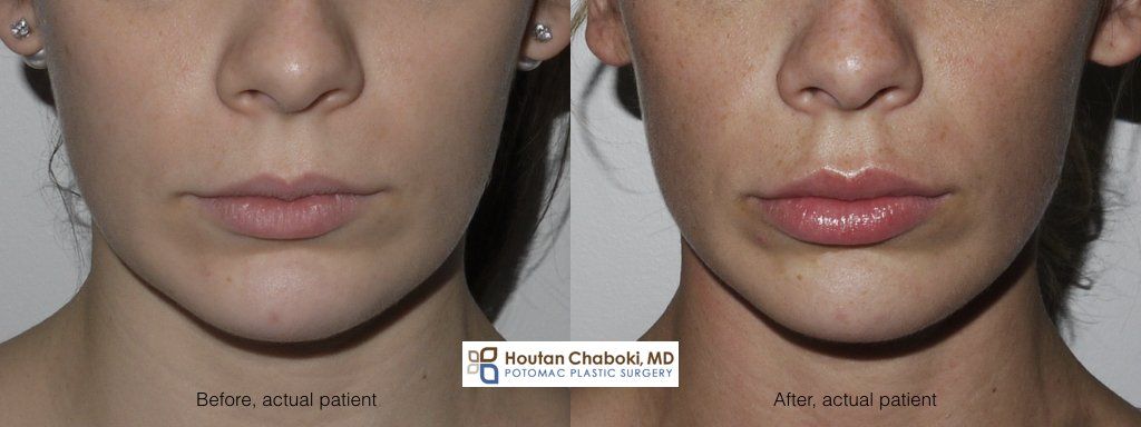 best of From fillers Swelling facial