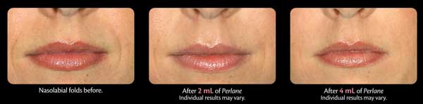 Polar reccomend Swelling from facial fillers