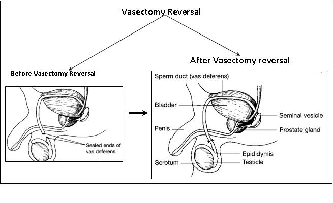 best of Sperm Vas counts reversal